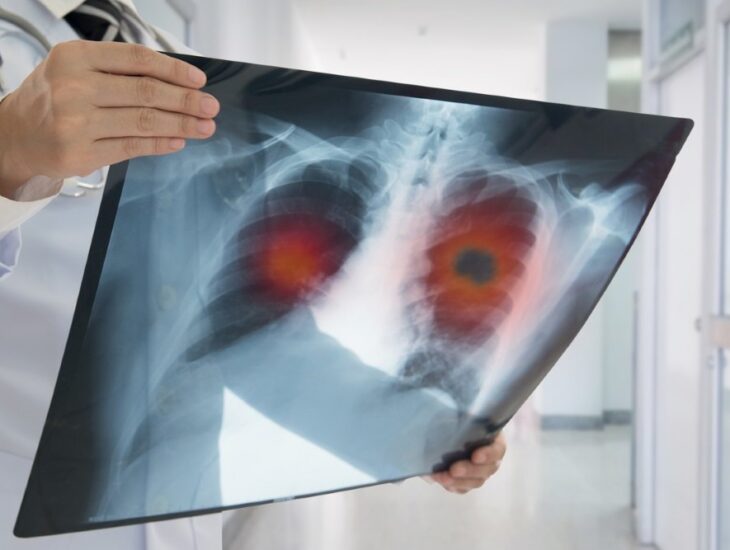 В Днепре выписывают домой пациентку, у которой коронавирус поразил 95% легких | Прихист 